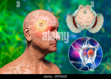 La substantia nigra. Illustration de l'ordinateur un dégénéré substantia nigra dans la maladie de Parkinson. La substantia nigra joue un rôle important dans Banque D'Images