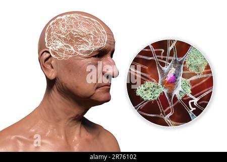 La maladie d'Alzheimer, illustration informatique conceptuelle montrant une personne âgée avec des déficiences progressives des fonctions cérébrales, plaques amyloïdes en br Banque D'Images