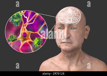 La maladie d'Alzheimer, illustration informatique conceptuelle montrant une personne âgée avec des déficiences progressives des fonctions cérébrales, plaques amyloïdes en br Banque D'Images