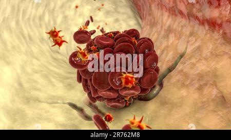 Caillot de sang dans un vaisseau sanguin endommagé composé de globules rouges, de plaquettes et de brins de protéines de fibrine. Thrombus, illustration informatique. Banque D'Images