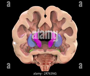 Illustration du striatum dorsal et des ventricules latéraux dans la maladie de Huntington. Agrandissement des cornes antérieures des ventricules latéraux (foncé Banque D'Images