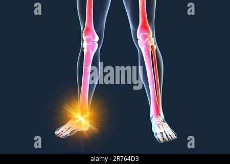 Cheville douloureuse, illustration informatique. Banque D'Images