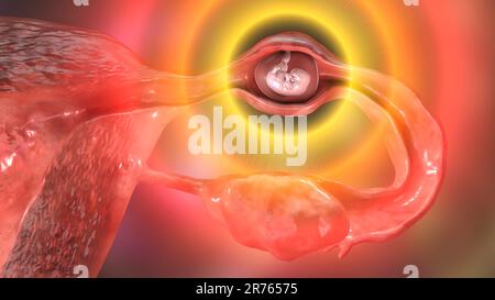 Grossesse extra-utérine, de l'illustration. L'embryon a implanté dans la trompe de Fallope, et non dans l'utérus. Banque D'Images