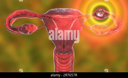 Grossesse extra-utérine, de l'illustration. L'embryon a implanté dans la trompe de Fallope, et non dans l'utérus. Banque D'Images
