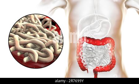 Vers ronds dans le gros intestin humain, illustration informatique. Les vers ronds, ou nématodes, comprennent de nombreuses espèces sauvages et pathogènes. Ver à broche (Entero Banque D'Images