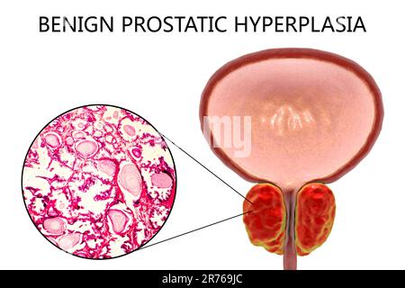 Micrographe léger (à gauche) et illustration de l'ordinateur (à droite) montrant l'hyperplasie bénigne de la prostate. L'hyperplasie décrit une augmentation du nombre de cellules due Banque D'Images