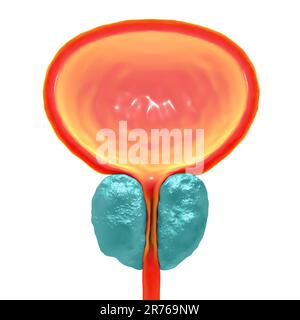 Illustration de l'hyperplasie bénigne de la prostate. L'excès de croissance des cellules normales à l'intérieur de la glande conduit à la formation de nodules. Agrandissement de la prostate t Banque D'Images