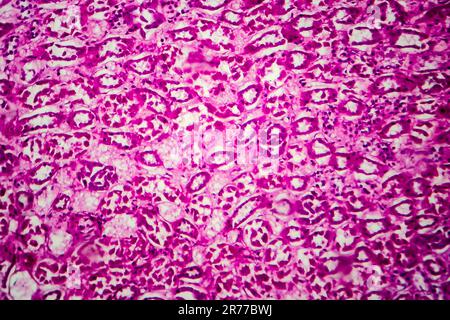 Glomérulonéphrite. Micrographe léger d'un tissu d'un rein dans un cas de glomérulonéphrite sclérosante diffuse. Banque D'Images