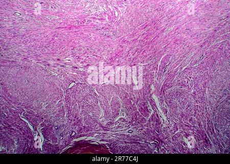 Les fibromes utérins. La lumière microphotographie (LM) d'une section à travers les tissus de l'utérus, dans le cas d'un léiomyome utérin (fibromes). Un fibrome est une bénigne Banque D'Images