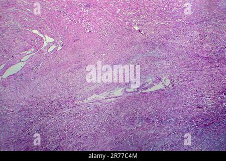 Les fibromes utérins. La lumière microphotographie (LM) d'une section à travers les tissus de l'utérus, dans le cas d'un léiomyome utérin (fibromes). Un fibrome est une bénigne Banque D'Images