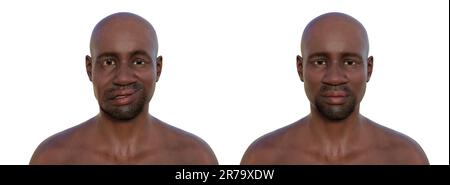 Paralysie faciale chez un homme africain et le même homme en bonne santé, illustration photoréaliste 3D soulignant l'asymétrie et le coulure des muscles faciaux Banque D'Images