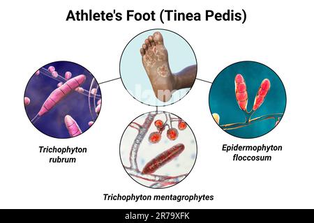 Le pied d'une personne à peau foncée avec mycose, et vue rapprochée des champignons Epidermophyton floccosum, Trichophyton mentagrophytes et T. rubrum qui ca Banque D'Images