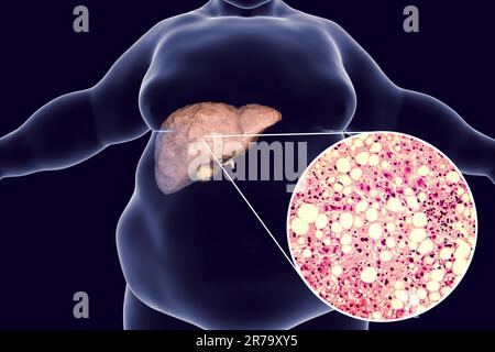 Homme obèse avec foie gras, 3D illustration et photomicrographie de la stéatose hépatique. Image conceptuelle de la stéatose hépatique non alcoolique Banque D'Images