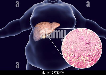 Homme obèse avec foie gras, 3D illustration et photomicrographie de la stéatose hépatique. Image conceptuelle de la stéatose hépatique non alcoolique Banque D'Images