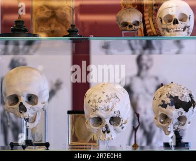 Berlin, Allemagne. 12th juin 2023. Divers crânes avec et sans blessures (blessure par balle guérie à la mâchoire inférieure (l) et graves anomalies osseuses syphiliques sont exposés comme des préparations sèches du 18th siècle dans le Musée d'histoire médicale (BMM) de la Charité. Le musée rouvre sur 15 juin 2023, après trois ans de rénovation et de modernisation. L'infrastructure touristique et les services de construction des sept étages ont également été renouvelés. L'exposition spéciale "le cerveau dans la science et l'art" commencera également à l'ouverture. Crédit : Soeren Stache/dpa/Alay Live News Banque D'Images