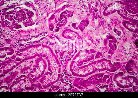 Glomérulonéphrite. Micrographe léger d'un tissu d'un rein dans un cas de glomérulonéphrite sclérosante diffuse. Banque D'Images