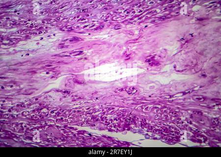 Les fibromes utérins. La lumière microphotographie (LM) d'une section à travers les tissus de l'utérus, dans le cas d'un léiomyome utérin (fibromes). Un fibrome est une bénigne Banque D'Images