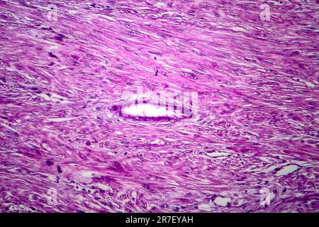 Les fibromes utérins. La lumière microphotographie (LM) d'une section à travers les tissus de l'utérus, dans le cas d'un léiomyome utérin (fibromes). Un fibrome est une bénigne Banque D'Images