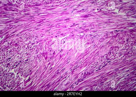 Les fibromes utérins. La lumière microphotographie (LM) d'une section à travers les tissus de l'utérus, dans le cas d'un léiomyome utérin (fibromes). Un fibrome est une bénigne Banque D'Images