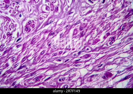 Les fibromes utérins. La lumière microphotographie (LM) d'une section à travers les tissus de l'utérus, dans le cas d'un léiomyome utérin (fibromes). Un fibrome est une bénigne Banque D'Images