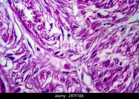 Les fibromes utérins. La lumière microphotographie (LM) d'une section à travers les tissus de l'utérus, dans le cas d'un léiomyome utérin (fibromes). Un fibrome est une bénigne Banque D'Images