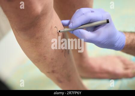 Jambes du patient sur lesquelles le chirurgien marque les varices Banque D'Images