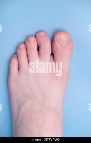 Système Unibrace sur la jambe d'un adolescent dans le traitement d'un ongle incarné, sur fond bleu. Système de correction des ongles Banque D'Images