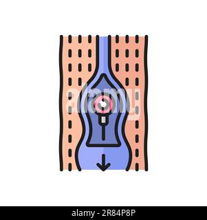 Icône de contour de couleur de flux sanguin anormal, thrombose et maladie cardiovasculaire. Vecteur varice pas fermé valve endommagée, sang circulant dans les deux directions Illustration de Vecteur