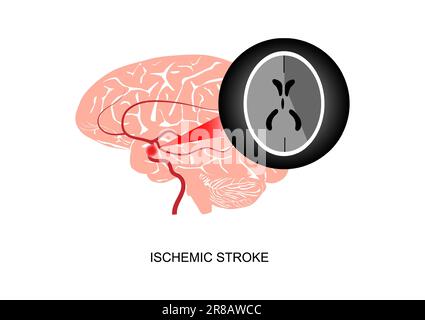 Illustration d'un infarctus cérébral ou d'un accident vasculaire cérébral ischémique et imagerie de l'acquisition CT . Illustration de Vecteur