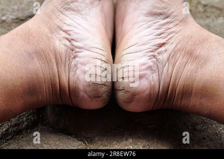 Talons secs et fissurés en raison du manque d'humidité dans les pieds Banque D'Images