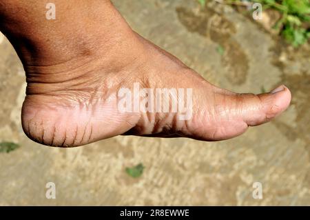 Talons secs et fissurés en raison du manque d'humidité dans les pieds Banque D'Images