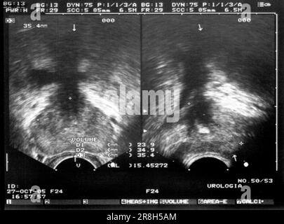 Échographie. Prostate Banque D'Images