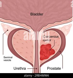 Schéma médical des 2 stades du cancer de la prostate. la tumeur se développe et pénètre dans les organes et tissus voisins. illustration vectorielle. Illustration de Vecteur