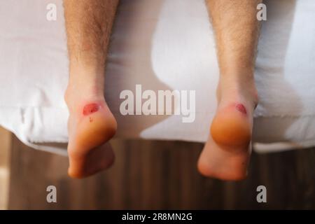 Pieds avec vue rapprochée sur le dessus et callosités sur les talons d'un homme méconnaissable allongé sur une table de massage dans un salon de spa de luxe. Gros plan sur une prise de vue courte de douloureuse Banque D'Images