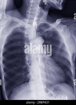 Examen de l'étude de baryum Swallow diagnostic de Barrett examen du tractus gastro-intestinal GERD série ulcères difficulté procédure pharynx UGI gorge traitement de l'intestin par fluoroscopie dev Banque D'Images