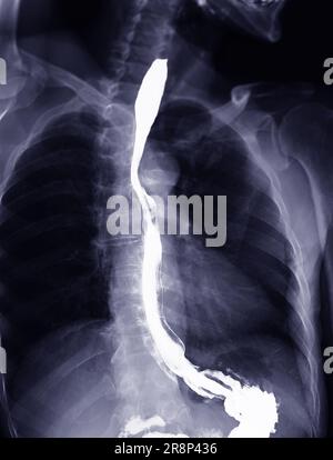 Examen de l'étude de baryum Swallow diagnostic de Barrett examen du tractus gastro-intestinal GERD série ulcères difficulté procédure pharynx UGI gorge traitement de l'intestin par fluoroscopie dev Banque D'Images