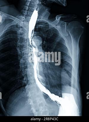 Examen de l'étude de baryum Swallow diagnostic de Barrett examen du tractus gastro-intestinal GERD série ulcères difficulté procédure pharynx UGI gorge traitement de l'intestin par fluoroscopie dev Banque D'Images