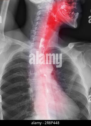 Examen de l'étude de baryum Swallow diagnostic de Barrett examen du tractus gastro-intestinal GERD série ulcères difficulté procédure pharynx UGI gorge traitement de l'intestin par fluoroscopie dev Banque D'Images