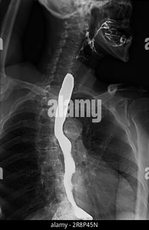 Examen de l'étude de baryum Swallow diagnostic de Barrett examen du tractus gastro-intestinal GERD série ulcères difficulté procédure pharynx UGI gorge traitement de l'intestin par fluoroscopie dev Banque D'Images