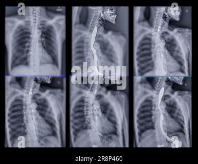 Examen de l'étude de baryum Swallow diagnostic de Barrett examen du tractus gastro-intestinal GERD série ulcères difficulté procédure pharynx UGI gorge traitement de l'intestin par fluoroscopie dev Banque D'Images