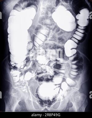 Image de l'étude de l'enema de baryum ou image radiographique de l'intestin grêle . Banque D'Images