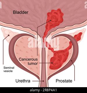 Schéma médical du 4 stade du cancer de la prostate. la tumeur se développe et pénètre dans les organes et tissus voisins. De la petite tumeur à la vessie atteinte ve Illustration de Vecteur