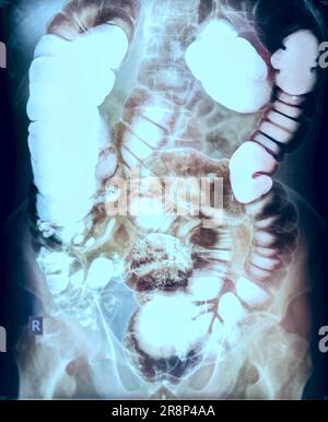 Image de l'étude de l'enema de baryum ou image radiographique de l'intestin grêle . Banque D'Images