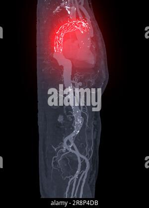 CTA aorte entière avec endoprothèse thoracique 3D rendu de l'image en cas d'anévrismes aortiques abdominaux. Banque D'Images