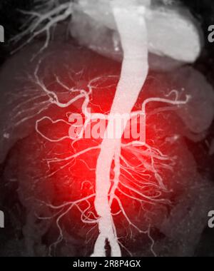 Rendu de l'aorte complète CTA 3D. Banque D'Images