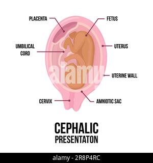 Présentation normale du bébé céphalique. Position du fœtus dans l'utérus pendant la grossesse. Illustration vectorielle médicale colorée. Fœtus avec cordon ombilical et place Illustration de Vecteur