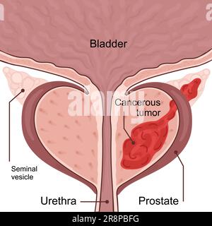 Schéma médical des 3 stades du cancer de la prostate. la tumeur se développe et pénètre dans les organes et tissus voisins. De la petite tumeur à la vessie atteinte Illustration de Vecteur