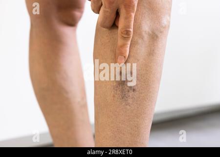 Avant après l'inflammation de la cellulite jambes traitement gros plan Banque D'Images