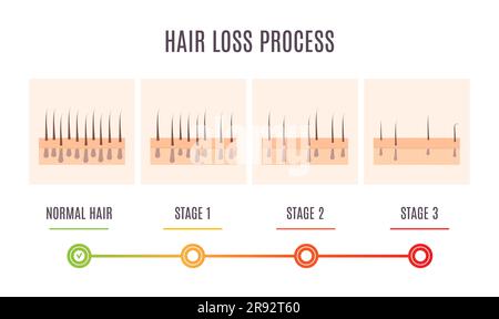 Processus de perte de cheveux, illustration conceptuelle Banque D'Images