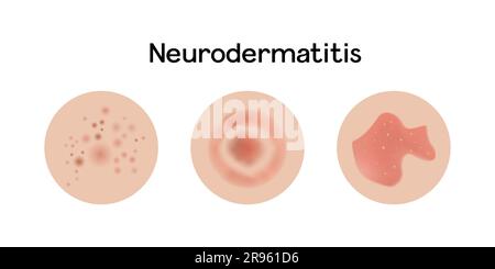 Exemples de neurodermatite vecteur illustration conception, problèmes allergiques Illustration de Vecteur